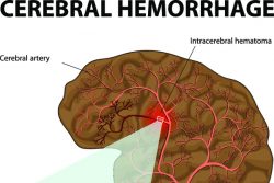 Внутричерепные гематомы: причины, симптомы, методы диагностики и лечения, реабилитация и прогнозы