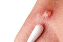 Лечение фурункула в домашних условиях