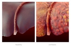 Цирроз печени: признаки, симптомы и лечение