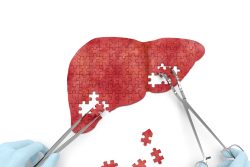 Гемангиома печени — лечение