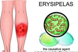 Рожа: классификация и особенности клинических проявлений