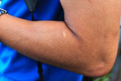 Почему бегут мурашки по коже?