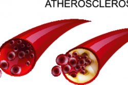 Очищение сосудов от атеросклеротических бляшек и тромбов