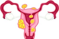 Фибромиома матки – лечение