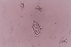 Соскоб на энтеробиоз: как берут у детей