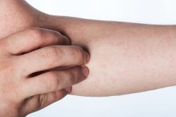 Синдром Чарга-Стросса: причины, симптомы, принципы лечения