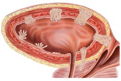 Рак мочевого пузыря у мужчин: симптомы, диагностика и лечение