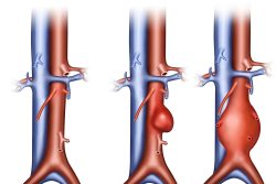Аневризма аорты, симптомы