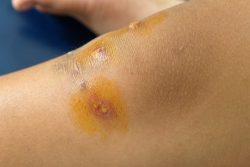 Пиодермия: что это такое, способы лечения