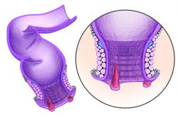 Обзор средств от геморроя для лечения дома