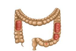 Полипы в кишечнике: симптомы и лечение