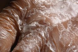 Заболевание кожи ихтиоз: причины возникновения, симптомы, лечение