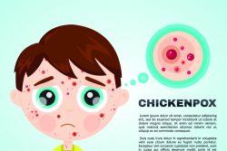 Ветряная оспа: лечение