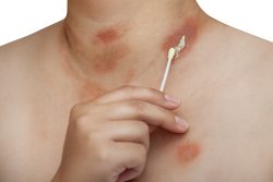 Появилось красное пятно на коже – что делать?