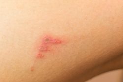 Импетиго: симптомы, лечение и профилактика