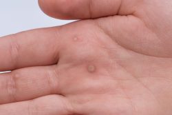 Бородавки: причины появления и методы лечения