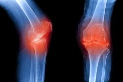 Хруст в суставах: причины и лечение