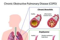 Хроническая обструктивная болезнь легких (ХОБЛ): причины, симптомы, лечение