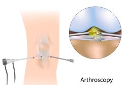 Реабилитация после артроскопии коленного сустава