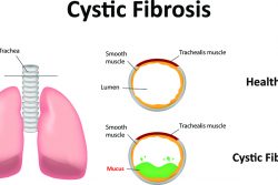 Муковисцидоз у детей: симптомы и лечение