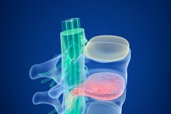 Межпозвоночная грыжа поясничного отдела позвоночника: симптомы, лечение и профилактика