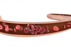 Профилактика тромбоза