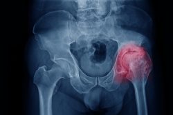 Артроз тазобедренного сустава: симптомы, лечение и профилактика