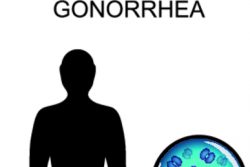 Гонорея у мужчин: симптомы и лечение
