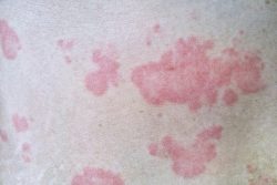 Дерматоз: виды дерматозов, лечение