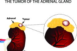 Гормонально-активные опухоли надпочечников: альдостерома, феохромоцитома