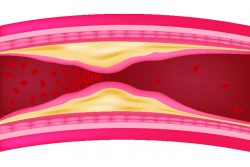 Как чистить сосуды в домашних условиях