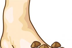 Грибок стопы: симптомы и лечение