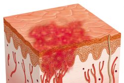 Геморрагический васкулит у детей: причины, симптомы и лечение