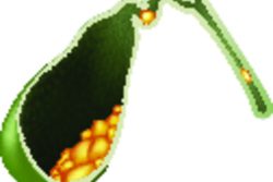 Камни в желчном пузыре: симптомы, причины и лечение