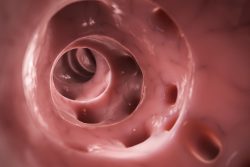 Дивертикулы сигмовидной кишки