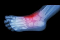 Реактивный артрит у детей: причины, симптомы и лечение