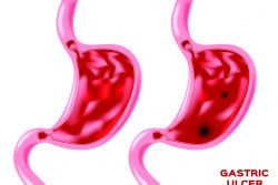 Диета при язвенной болезни