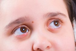 Халязион: лечение и последствия