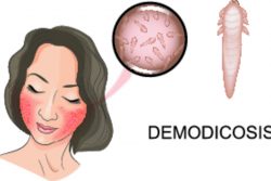 Демодекоз у человека: симптомы, лечение