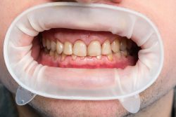 Лечение флюороза зубов