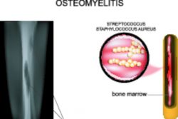 Признаки остеомиелита и лечение