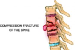 Компрессионный перелом позвоночника: лечение и реабилитация