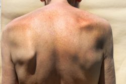 Сколиоз: симптомы, лечение и профилактика