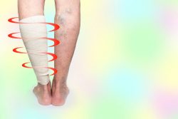 Тромбофлебит: симптомы и лечение