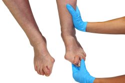 Как лечить косточку на ногах?