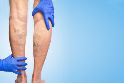 Тромбоз вен нижних конечностей: симптомы и лечение