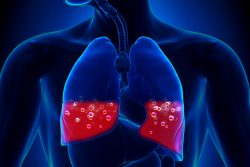 Отек легких: причины, симптомы, неотложная помощь