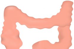 Дивертикулы толстой кишки