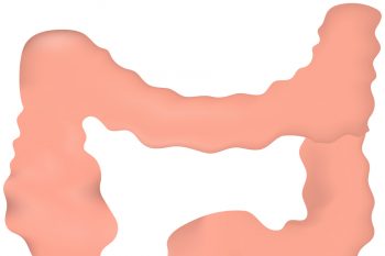 Дивертикулы толстой кишки