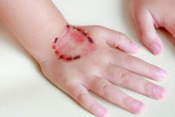 Прививка от бешенства человеку, лечение